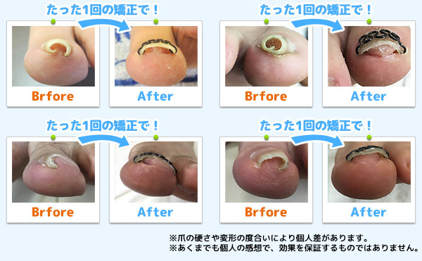 圧倒的な矯正力。たった1回の施術例です!!